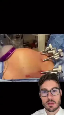 How we do robotic kidney transplants! Credits to dr. Eltemamy for this amazing video