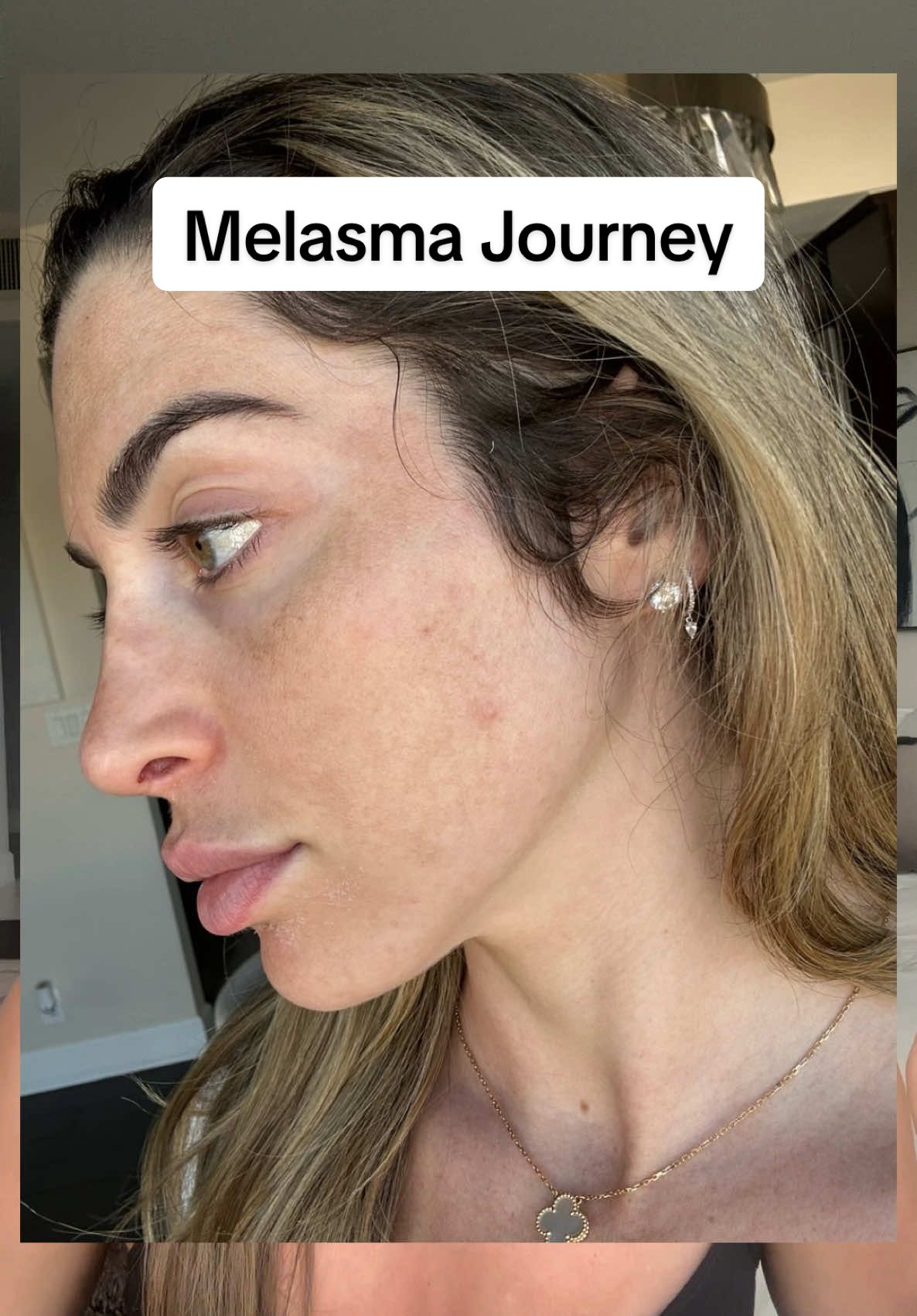 My melasma has nothing on The Spot Cream from @Musely. It’s been a journey but with consistency and the right product we’re getting there! 💕 #musely #darkspots #melasma #acnescars #hyperpigmentation #melasmatreamtent #darkspottreatment 