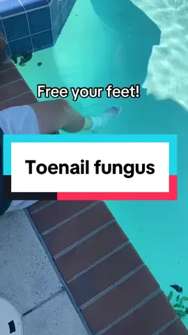 Swimming with socks is not the answer! There’s an easier way to deal with your yellow cracked toenails! #lunavia #antifungalpen #toenailfungus #resultsmayvary #yellowtoenails 