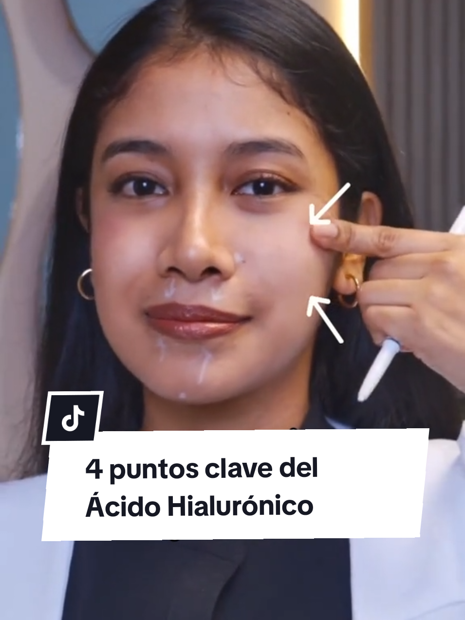 ZONAS ESTRATÉGICAS DE REJUVENECIMIENTO CON ÁCIDO HIALURÓNICO:  LOS PUNTOS DE ANCLAJE tienen una función específica: sustentar, reestructurar y hacer un efecto lifting en ciertas zonas del rostro.  ADEMÁS se pueden aplicar en líneas de envejecimiento profundas para devolver armonía y frescura en la expresión.  En Cuidamedic, analizamos tu simetría facial y tus necesidades para diseñar un plan personalizado.💉 Porque una buena técnica no solo se nota... se siente. ✨ #Cuidamedic #ÁcidoHialurónico #RejuvenecimientoFacial #Belleza #Bienestar #ArmonizaciónFacial #PuntosDeAnclaje 