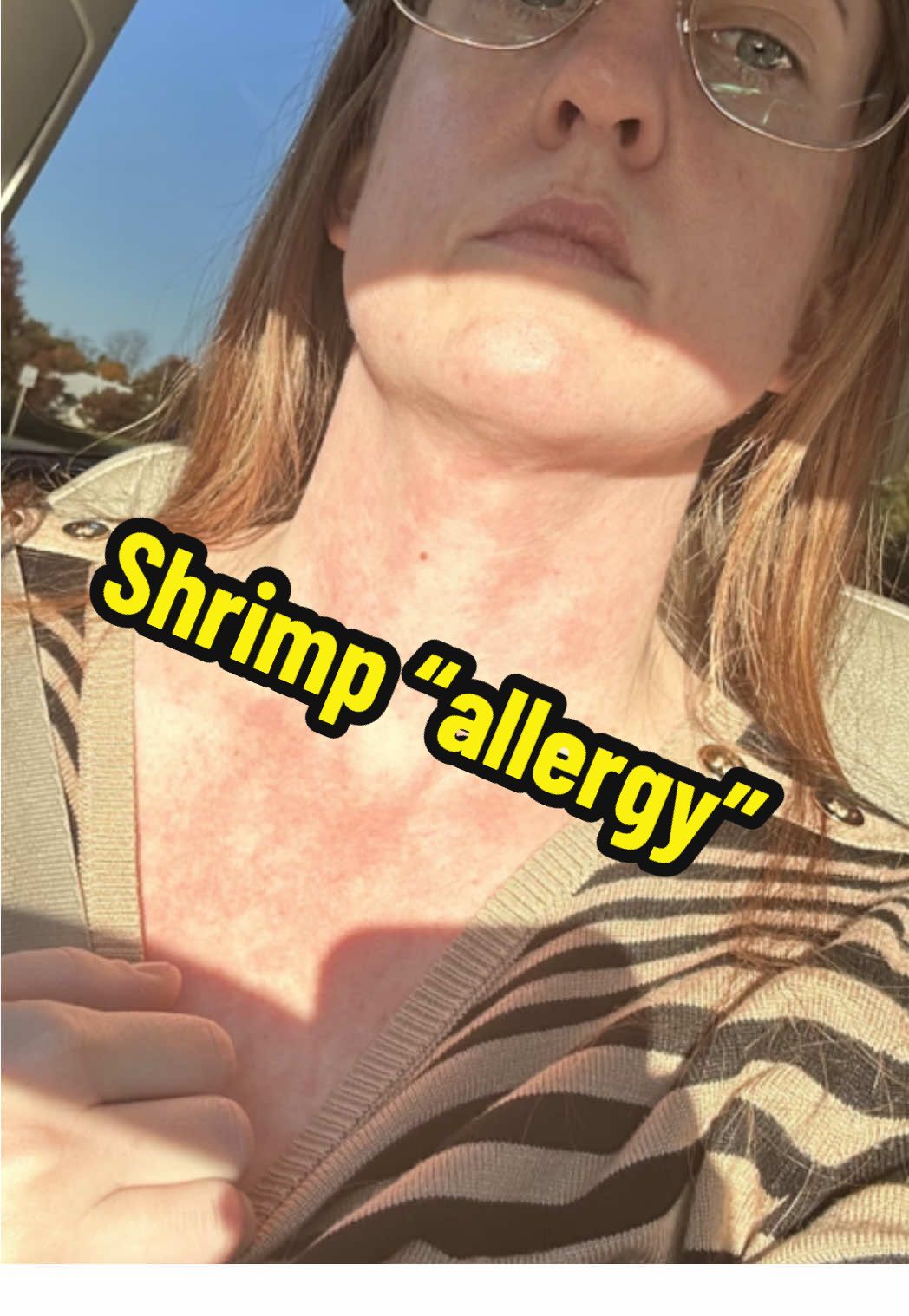 I haven’t posted in awhile but I’m back to remind you that American food is poison #foodallergies #foodallergyawareness #MCAS #mastcellactivationsyndrome #shrimpallergy