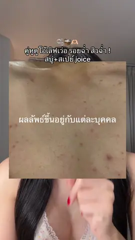 นี่แหละ กว่าจะมาดีขึ้นนนนน นานมากแม่ แต่ใช้มาตลอดไม่ขาดต้องมีติดบ้านน✅ #ป้ายยาบิวตี้ #รีวิวบิวตี้ #ป้ายยาtiktok #howtotiktok #tiktokthailand #howtobeauty  #tiktoklooks #ของดีบอกต่อ #joiceacneclear  