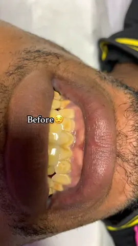 Before vs After #fypシ゚ #teethwhitening #scaling #polishing #blowthisup #500kviews #xyzbcafyp 