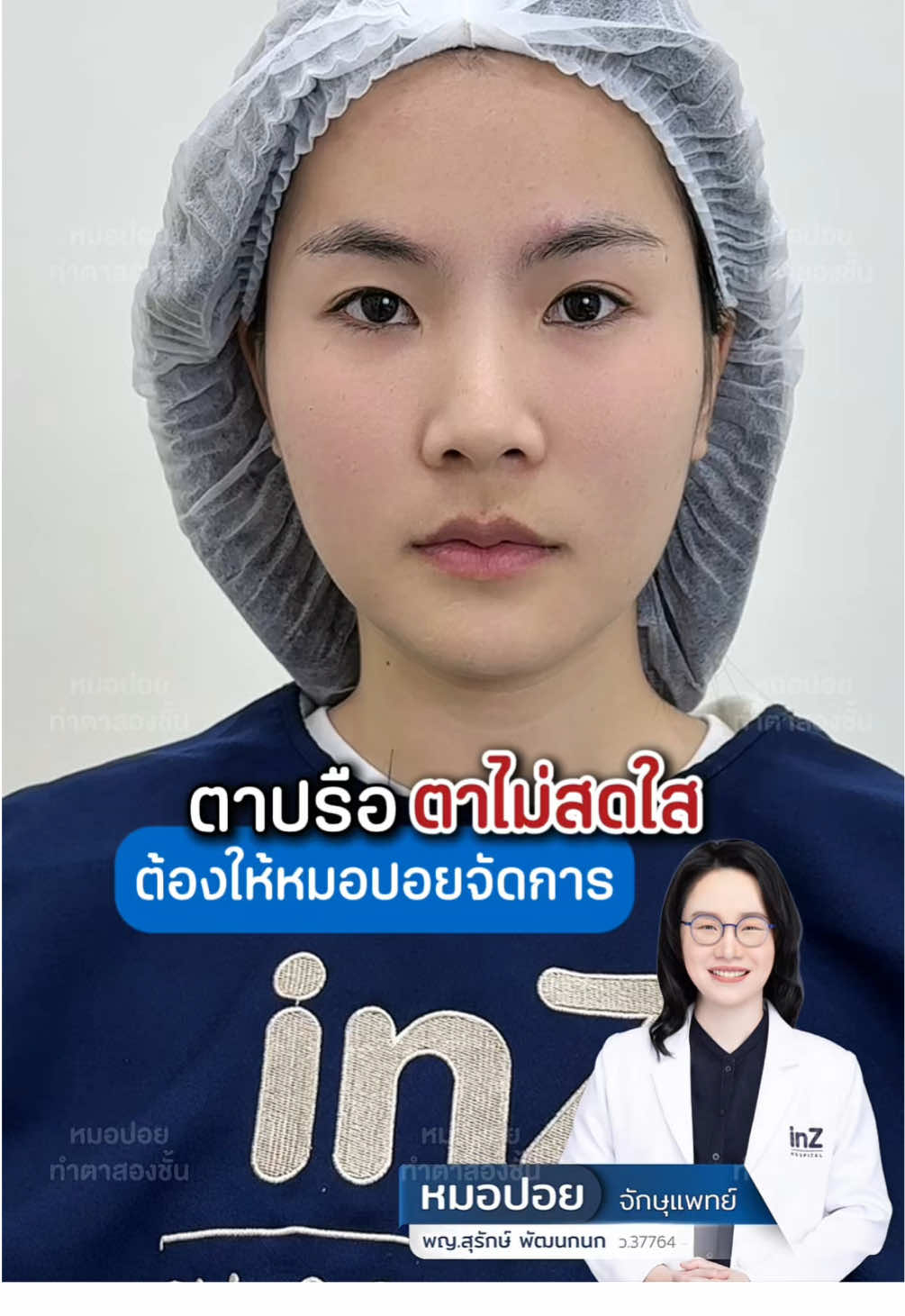 ตาปรือ ตาไม่สดใส ต้องให้หมอปอยจัดการ😎  @หมอปอย ทำตาสองชั้น  @หมอปอย ทำตาสองชั้น  @หมอปอย ทำตาสองชั้น  #หมอปอย #หมอปอยจักษุแพทย์ #inzhospital #inzsurgery #ศัลยกรรมตา #จักษุแพทย์ #ตาปรือ #ตาไม่สดใส #รีวิวบิวตี้ 