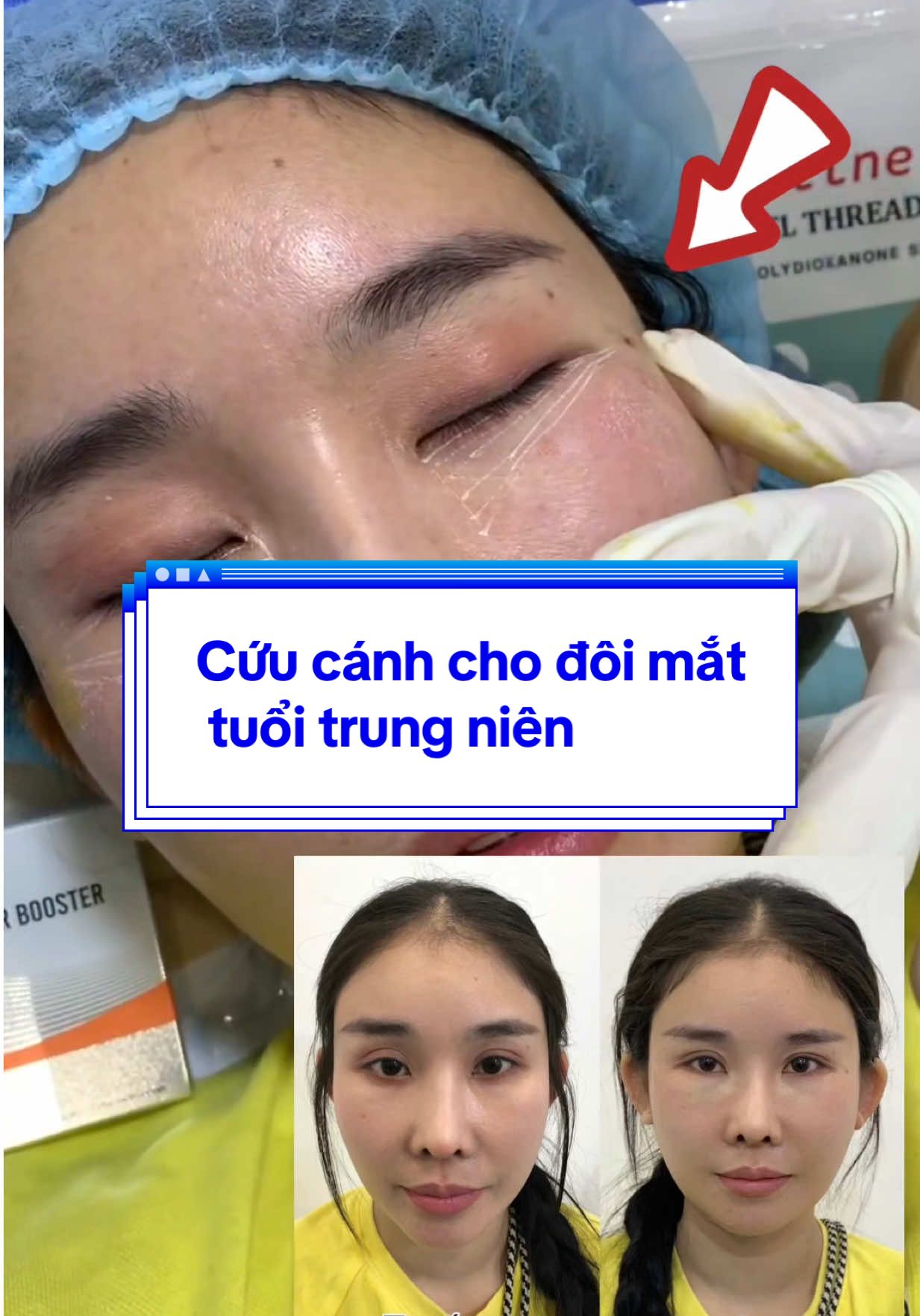 Đẹp đâu chỉ là da – vùng mắt trẻ mới là thần thái. Cấy chỉ BAM = cứu cánh cho đôi mắt trung niên! #lamdayhommat #ĐàoTạoCăngChỉ #nâng_cơ_táo #Filler #Mdcode #Thắt_Nọng_Cằm #căngchỉHQ #Shanghai #Nâng_Mũi_Chỉ #Cấy_chỉ_đầy_thái_dương #lamdep #vivaline #chiasexaykenh #nangtangmatgiua #chiasexuhuong #Cấy_chỉ_cơ_cau #Cấy_chỉ_rãnh_cười #Tiêm_Môi 