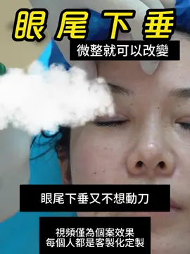 不用動刀改善眼尾下垂#台北 #台北醫美 #逆齡 #自然 #無痕 #微整 