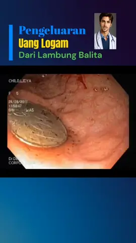 Uang koin ditemukan di lambung seorang anak umur 5 tahun. Koin ini bukan berada di tempat yang semestinya. Ini adalah benda asing yang tertelan oleh sang anak — tanpa sepengetahuan orang tua.  Kejadian seperti ini ternyata sangat sering terjadi, terutama pada anak-anak usia balita yang sedang aktif-aktifnya bereksplorasi dan memasukkan segala sesuatu ke dalam mulut. Bagi anak-anak, benda kecil seperti koin, baterai kecil, kancing, bahkan mainan mungil adalah hal yang menarik.  Tapi semua itu bisa berubah menjadi bahaya. Sayangi anak-anak kita. Mereka adalah anugerah, tapi juga tanggung jawab besar.  Waspada bukan berarti khawatir berlebihan, tapi bentuk cinta yang nyata dari orang tua. Semoga kejadian seperti ini tidak pernah terjadi pada anak-anak kita. #kointertelan #anak #balita #edukasiorangtua #wajibtahu #tipsorangtua #kesehatananak 