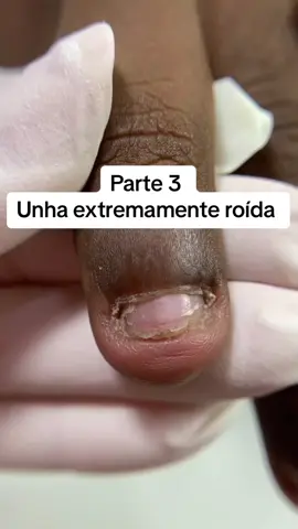 Parte 3 da unha mais roída desse feed 🫢 30 dias vencendo o vício de roer as unhas, e o resultado é de aplaudir em pé 👏🏼 Blindagem em unhas roídas são como um tratamento, fazemos cada etapa com período reduzido para incentivar a pessoa a não roer mais! Eu sinceramente estou amando esse resultado mas ainda queria alongar essas unhas 😅 E você também quer ver pelo menos um dedinho alongado comenta aqui “UNHA” e me ajuda a convencer esse cliente, nem que seja pelo engajamento 🫢  CONTO COM VOCÊS 👇🏼 #unharoida #nailtutorial #naildesigns #nails #cursounhadegel 