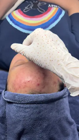 Các bạn cần tìm 1 spa nặn mụn bằng tay thì qua e nhé ! #mun #munviem #mundauden #munan #làmđẹp #nanmunbangtay 