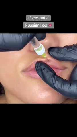 injection_paris_geneve - Augmenter le volume - ﻿﻿Correction des Asymétries - ﻿﻿Contours redessiner 1 ML appliquée Durée 6 - 12 Mois #russianlipstechnique #russianlips #acidehyaluronique #bellelevres #levrespulpeuses #injections