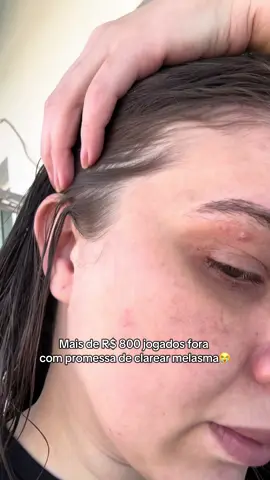 Já perdi as contas de quanto gastei tentando clarear minha pele🥹#usesaviora #clareadordemanchas #melasmatreatment #serum 