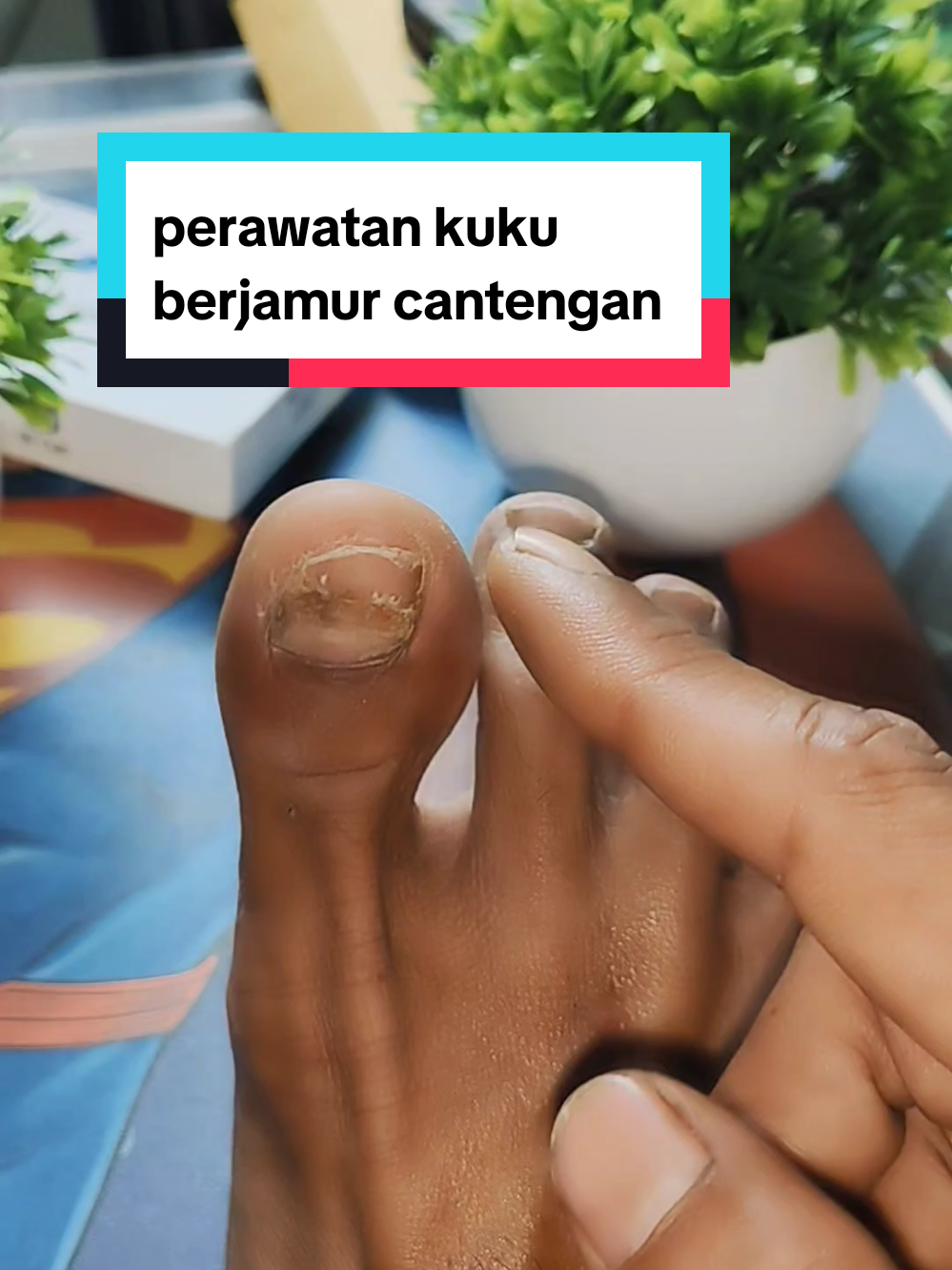 solusi kuku berjamur #fyp #virall #toenailserum 