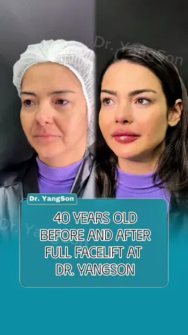 Dr. Yangson's facelift brings youthful beauty #24#facelift #necklift #tiktokmalaysia🇲🇾 #DrYangSon 