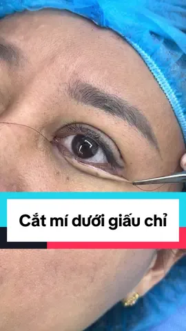 Xử lí da chùng mí mắt dưới sau 20 phút thực hiện #catmi #catmiduoi #catmidep  #nangcungchanmayrutchi #xuhuong #xuhuongtiktok #ilovetiktok 