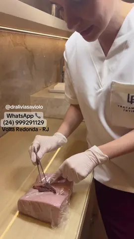 Caso de Ninfoplastia de hoje!   #draliviasaviolo #liviasaviolo #ginecologistavoltaredonda #ninfoplastia #labioplastia 