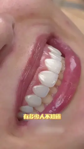 还在纠结牙贴面要磨多少牙？微创半手工瓷#医美