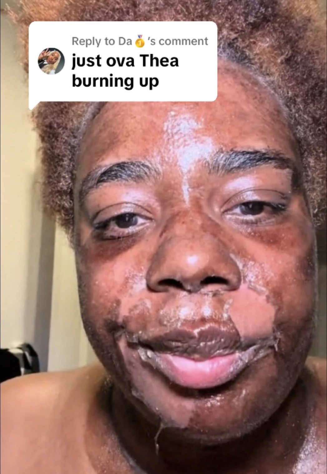 Replying to @Da🥇  this is actually funny lol chemical peel experience day 6. follow long with me….. there will be a HELLO pinned video on profile soon, you should think about checking it out. . #chemicalpeeljourney #hyperpigmentation #skincare #unevenskintone #SelfCare #chemicalpeelprocess #clearskin #clearskintment #darkspots #GlowUp #chemicalpeel #beauty #reinventingmyself #skinpeel #startingover #levelingup #BlackTikTok #facialtreatment #blackTikTokakeup #acnemarks #acnescars #glowingskin #medicalgradeskincare #transformation #becomingher #Lifestyle #chemicalfacepeel #chemicalfacepeelckgirl #chemicalpeelbeforeandafter #glassskin #face #lips #eyes #chemicalpeelcosmetic #ultabeauty #sephora #chemicalpeeling #CapCut 