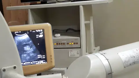 #makemefamous #kidney #stone #Fragment #ESWL #ultrasound #guided 