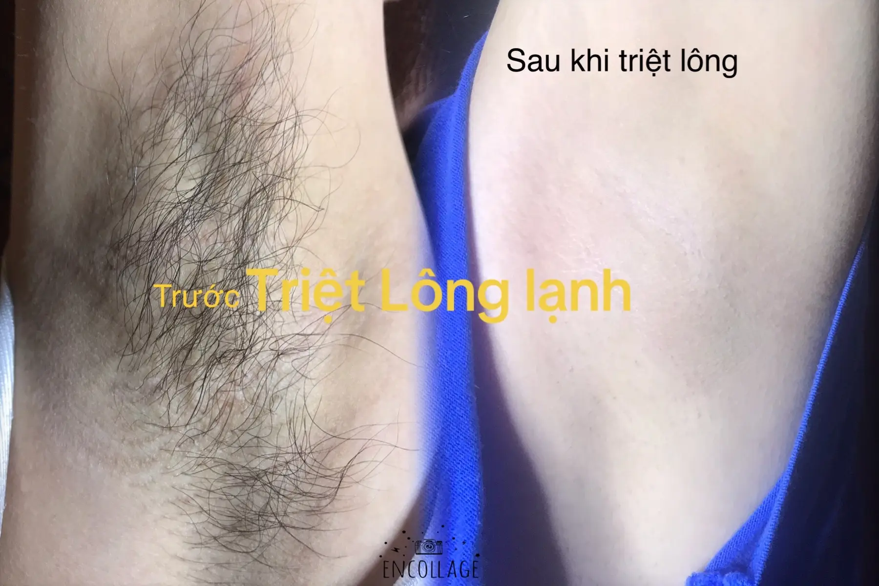 Triệt lông lạnh#spahunghue #xuhuong 