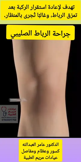 #الدكتور#عامر العبد الله #جراحة العظام والكسور والمفاصل 🔧 جراحة الرباط الصليبي الأمامي تهدف لإعادة استقرار الركبة بعد تمزق الرباط، وغالبًا تُجرى بالمنظار. - السبب: التواء أو حركة عنيفة - الطريقة: استبدال الرباط برقعة من أوتار المريض - المدة: ساعة تقريبًا - التأهيل: 4–6 أشهر - المضاعفات: تيبس، تورم، احتمال هشاشة مستقبلية #عيادات مريم الطبية التخصصية  بغداد حي الحسين شارع ٤٠ قرب مجمع الروان السكني 07830017758 https://maps.app.goo.gl/a16Ah9KPP6voPCNJ7