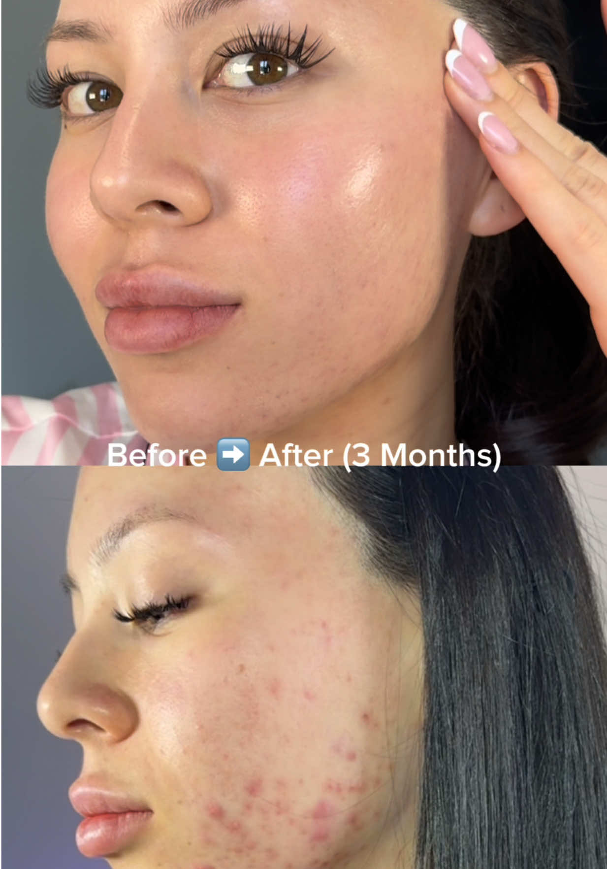 From breakouts to barely-there scars, it took me 3 months using this cream. My skin never felt more calm, clear, and balanced. Still a few scars left and a few more days to go. My forever restock 345 cream! #skincare #345reliefcream #beauty #acneproneskin #sensitiveskin #dralthea 