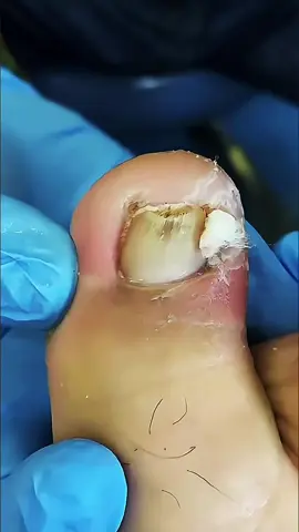 Before & After: The Ingrown Toenail Transformation! 👣 #toenailremoval #ingrowntoenail #pedicure #satisfying #viral #foryou #fyp