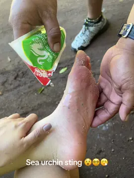Sea urchin sting 😵 #siquijorisland 