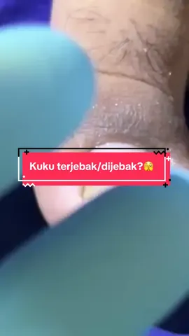 Kuku nyangkut?!🫣 #cantengan #doktercantengan #waduhwaduh #cantengantanpacabutkuku #podiatrist #pedicuretime #cabutkuku #nailcare #medicalpedicure #electro 