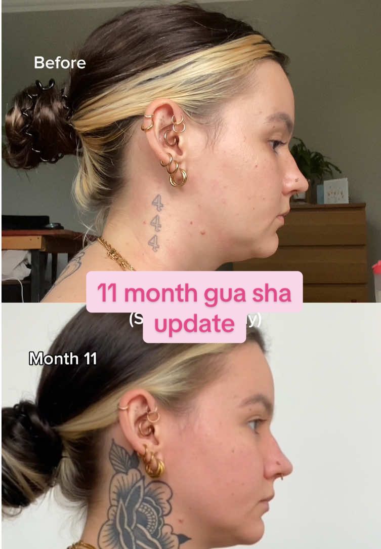 11 month gua sha update!!! #guasha #lymphaticdrainage #guasharesults #guashatool #results #lymphaticdrainagemassage #fyp 