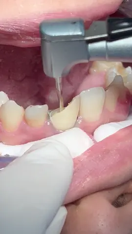 Composite restoration with fiber post for fractured anterior central incisor tooth #dentist #dental #dentistry 
