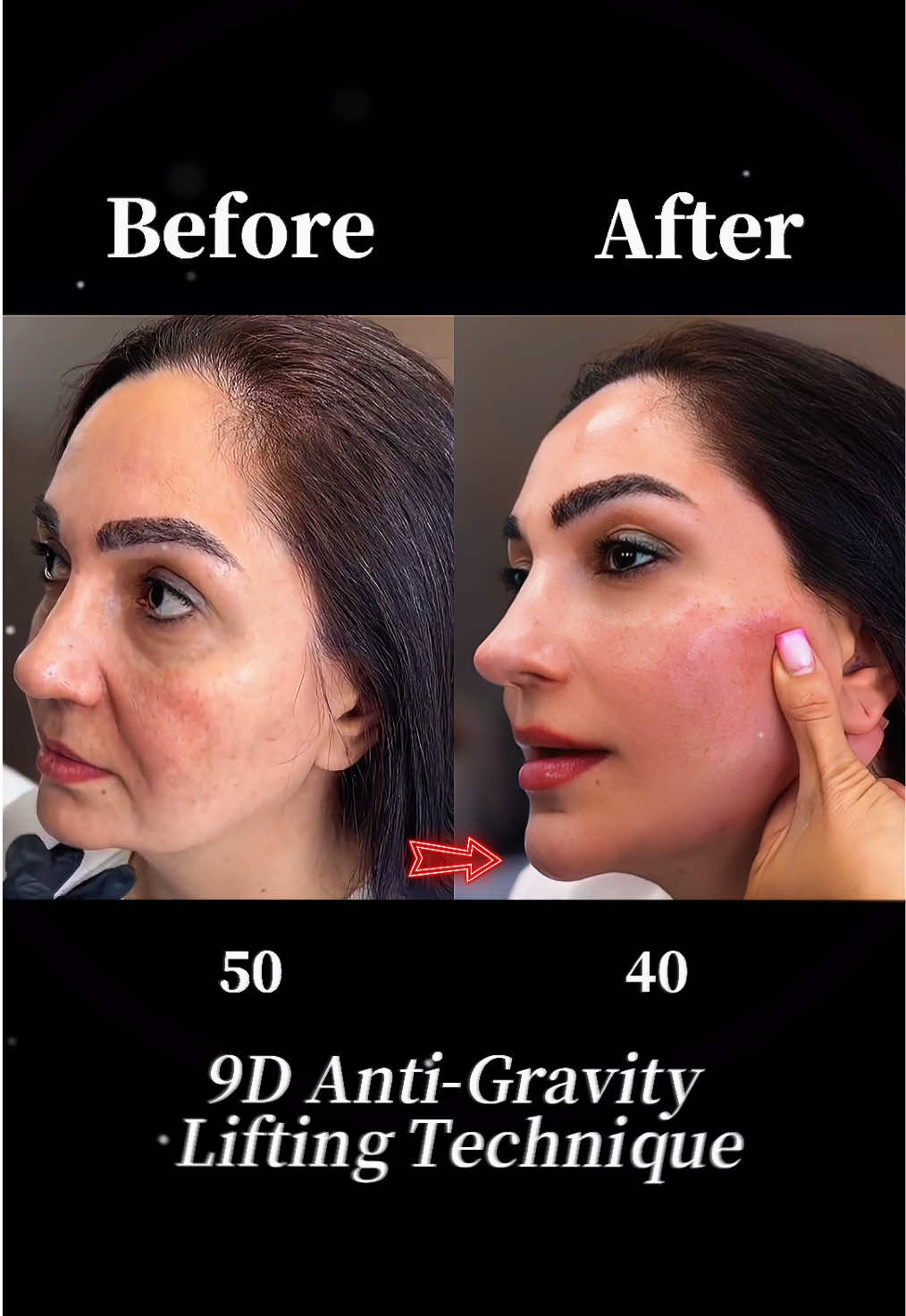 #facelift #antiaging #facelifting #plasticsurgery ‎#تركيز الوجه#拉皮手术 