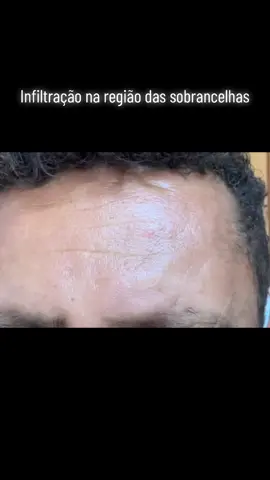 A face é uma região riquíssima em nervos, por isso frequentemente é acometida pala hanseniase. Neste vídeo, mostro a infiltração da pele (ela se torna grossa, espessada). A região da testa entre as sobrancelhas é chamada de glabela. E muito comum observarmos infiltração da glabela e sobre as sobrancelhas, na hanseniase . Essa infiltração nesses locais terminam dando um aspecto de rugas grosseiras, como se a pessoa estivesse sempre com cara de preocupado, com a testa franzida, mesmo que esteja com a testa relaxada. Você já percebeu isso em alguém ?  #hanseníase #neuropatia #fibromialgia #dorcronica #queimaçãonospés #queimacaonasmaos 