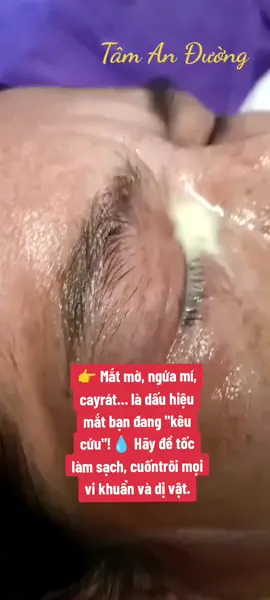 👉 Mắt mờ, ngứa mí, cay rát… là dấu hiệu mắt bạn đang 