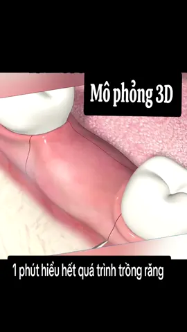 Trồng răng= đau, nguy hiểm, tốn thời gian? Trồng răng Implant gồm 4 bước đơn giản: ✅ Khám & chụp phim ✅ Cắm trụ titanium ✅ Chờ lành thương (2-3 tháng) ✅ Gắn răng sứ hoàn chỉnh 👉 Không đau – An toàn – Ăn nhai như răng thật! 📩 Inbox ngay cho bác sĩ để được tư vấn và hỗ trợ trực tiếp  #nhakhoaNKaesthetic #bacsinhakhoa #NhaKhoaUyTin #trongrangimplant #trongrangkhongdau  #implant 