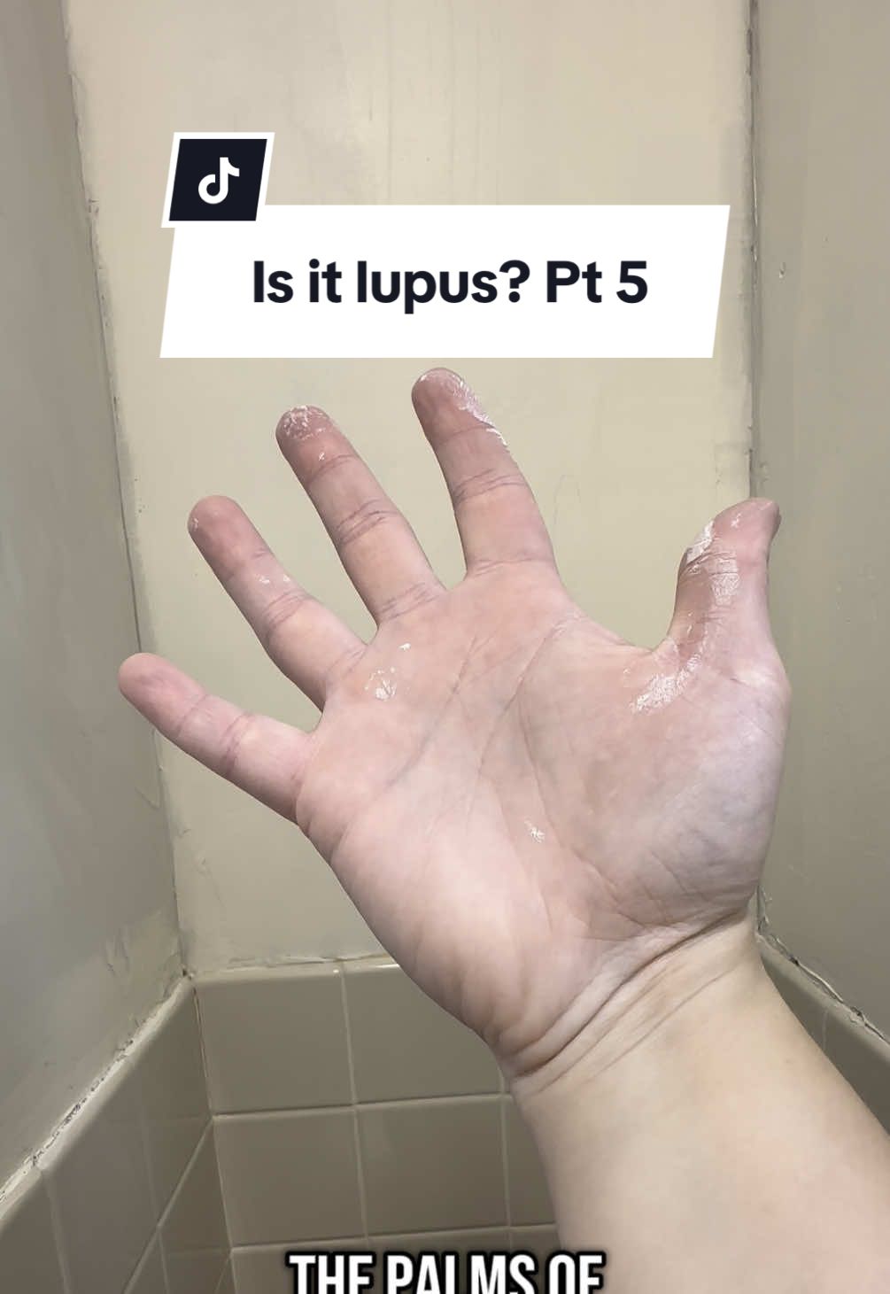 I started this series to highlight the many symptoms I experienced and continue to experience that I didn’t know were from lupus.  #lupuswarrior #lupus #lupusawareness #sle #lupuswarrior🦋💜 #lupuswarrior💜 #autoimmune #autoimmunedisease #invisibleillness 