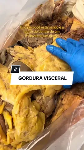 Gordura visceral 😱⚰️ #anatomiaplena 