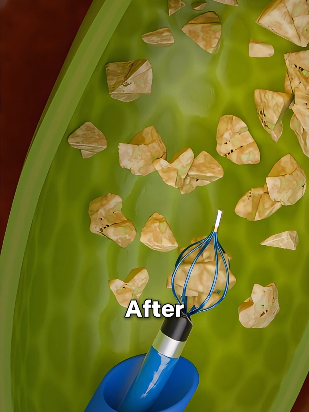 See How Gallstones Are Removed! 🔍 Cholangioscopy Explained in 60 Seconds #Cholangioscopy #Gallstones #GallbladderHealth #Endoscopy  #medbuzz360 
