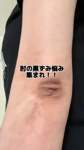 左手はキテンで実証してみたよ✨肘の黒ずみ悩みある人集まれ‼️コレは凄い✨ #pr #肘#黒ずみ#肘の黒ずみ#シミ#キテンハイドロキノンクリーム#キテン