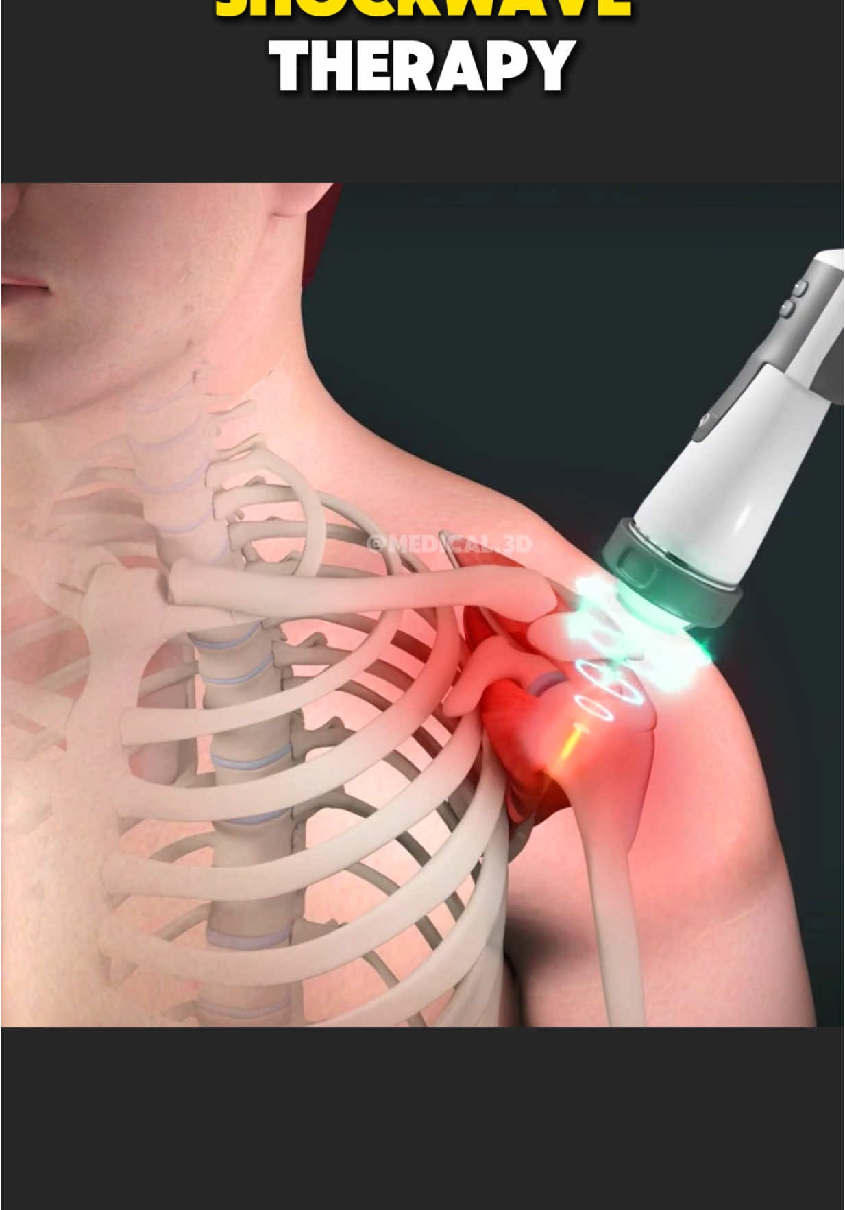 Shockwave Therapy (3D Animation) #shockwavetherapy #shockwave #peyroniesdisease #peyroniestreatment #musclepainrelief #musclepain #scartissuetreatment #medical3danimation #3medicalanimation 