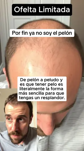Por fin ya no soy el pelón #hombres #calviciemasculina #crecimientodelcabello 