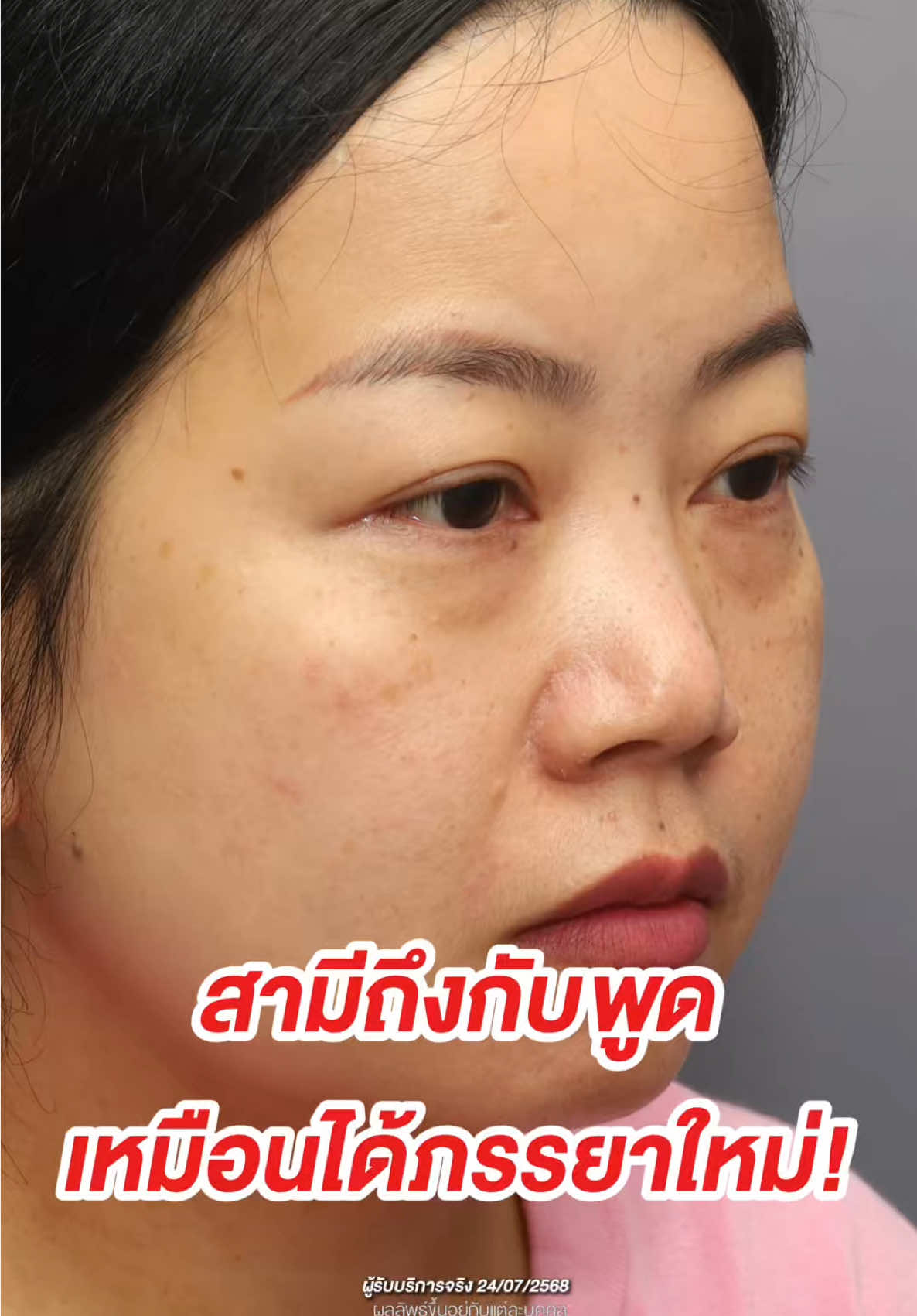 จมูกแท่งเดียวเปลี่ยนทั้งหน้า สาวหน้ากลมแบนขาดมิติ พอเติมจมูกเข้าไปอย่างเหมาะสม ทำให้โดยรวมหน้าดูละมุนขึ้นสวยขึ้นมากเลย #หมอเชs45clinic #s45clinic #เสริมจมูก #รีวิวจมูก #แก้จมูก 