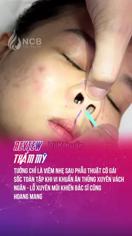 Vi khuẩn ăn thủng vách ngăn mũi #tintuc24h #reviewthammy #fyp 