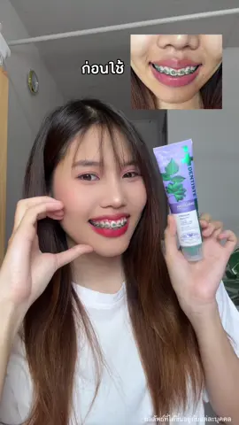 ถึงจะใส่เหล็กจัดฟันแต่ก็ยิ้มสวยมั่นใจได้แบบลิซ่าเพราะใช้ยาสีฟันตัวนี้เลย 💜✨✅🙌🏻 #ยาสีฟันหลอดม่วง #ยิ้มสวยมั่นใจ #DentistePurpleToothpaste #ลมหายใจหอมสดชื่น #LisaxDentiste #PremiumCare #ครบจบปัญหาเหงือกและฟัน 