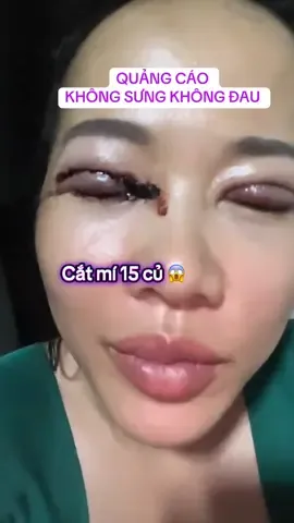 🌏 PHẪU THUẬT CẮT MÍ #TriSeoPhauThuat #XuanNguyen_ColdPlasma #LangLeTaiSinh #SimpleBeauty #phẫu_thuật_thẩm_mỹ #TRISEORO #ColdPlasmaChuanHan #SpaDieuTriChuyenSau #PLASMAAI