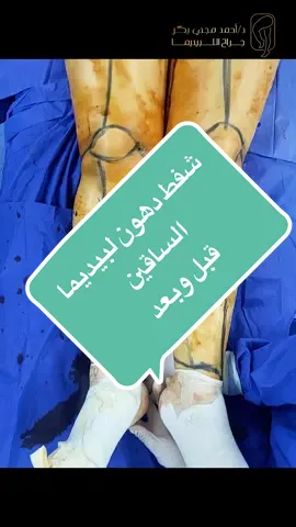 شفط دهون لبيديما الساقين قبل وبعد#lipedemawarriors #lipedemasurgery #lipedemaacademy #lipedemafighter #lipedemalegs #lipedemabrasil #lipedemaawarenes #lipedemagirl #وذمة #ليبيديما #وذمة_شحمية #lipedema #وذمه_لمفاويه 