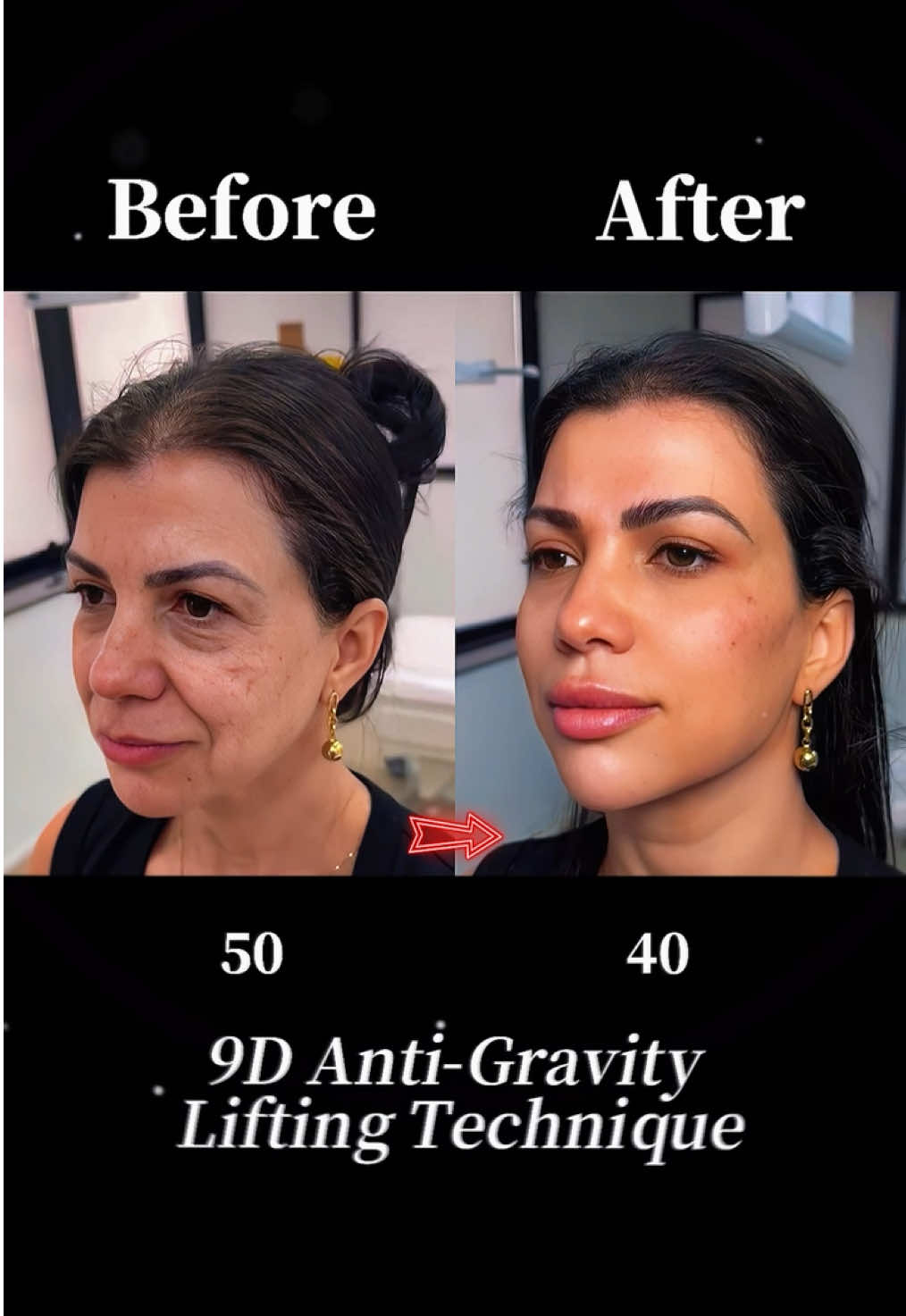 #facelift #antiaging #facelifting #plasticsurgery ‎#تركيز الوجه#拉皮手术 