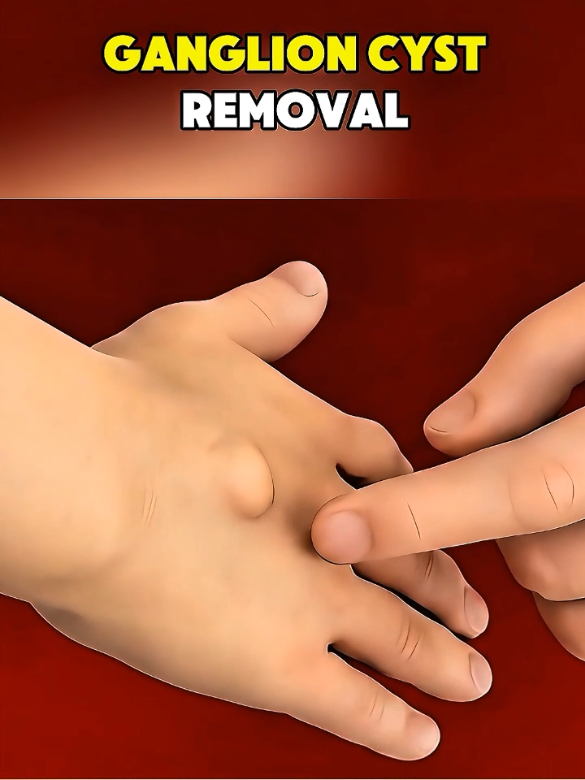 Ganglion cyst Removal #GanglionCyst #CystRemoval #JointHealth #HandSurgery #OrthopedicCare      A ganglion cyst may seem harmless—a small, fluid-filled lump near a joint—but it can cause discomfort or limit movement. Here's a quick look at how removal can bring lasting relief.