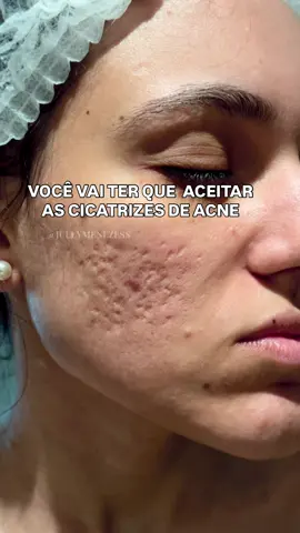 Vai ser seu caso ? Trato cicatriz a mais de 5 anos!  #fy #foryoupage #pele #cicatrizdeacne