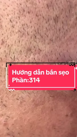 Chủ spa muốn chỉnh máy bắn sẹo ntn cmt e hướng dẫn cho nha !!! #oanh_chuyên_trị_nám #chuyên_giải_quyết_các_vấn_đề_về_da #điều_trị_nám #oanh_chuyên_nám #nám #tăng_sắc_tố_da #peel_nám #co2laser 