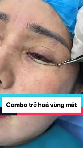 Combo trẻ hoá vùng mắt cho chị khách hàng u60 😍 #nangcungchanmayrutchi #nangcung #nangcungmay #nângcungchânmày #ilovetiktok 